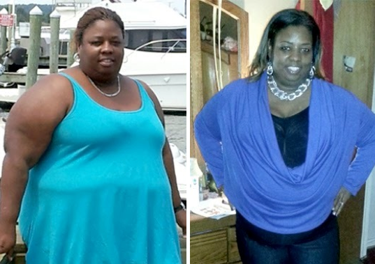 Bariatric Success Stories - Sterling Surgicare