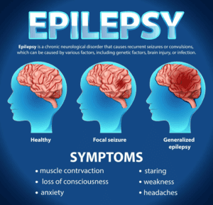epilepsy symptoms Neurological Disorder